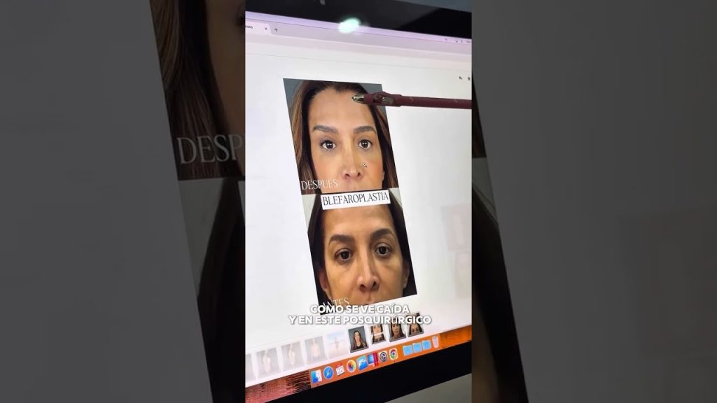 Blefaroplastia: qué es la cirugía de párpados, cómo se realiza y qué cambios produce en tu mirada Blefaroplastia: qué es la cirugía de párpados, cómo se realiza y qué cambios produce en tu mirada